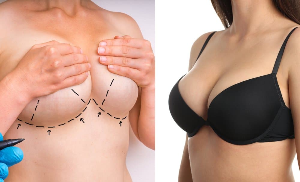 Breast augmentation vs breast lift - picking the right procedure