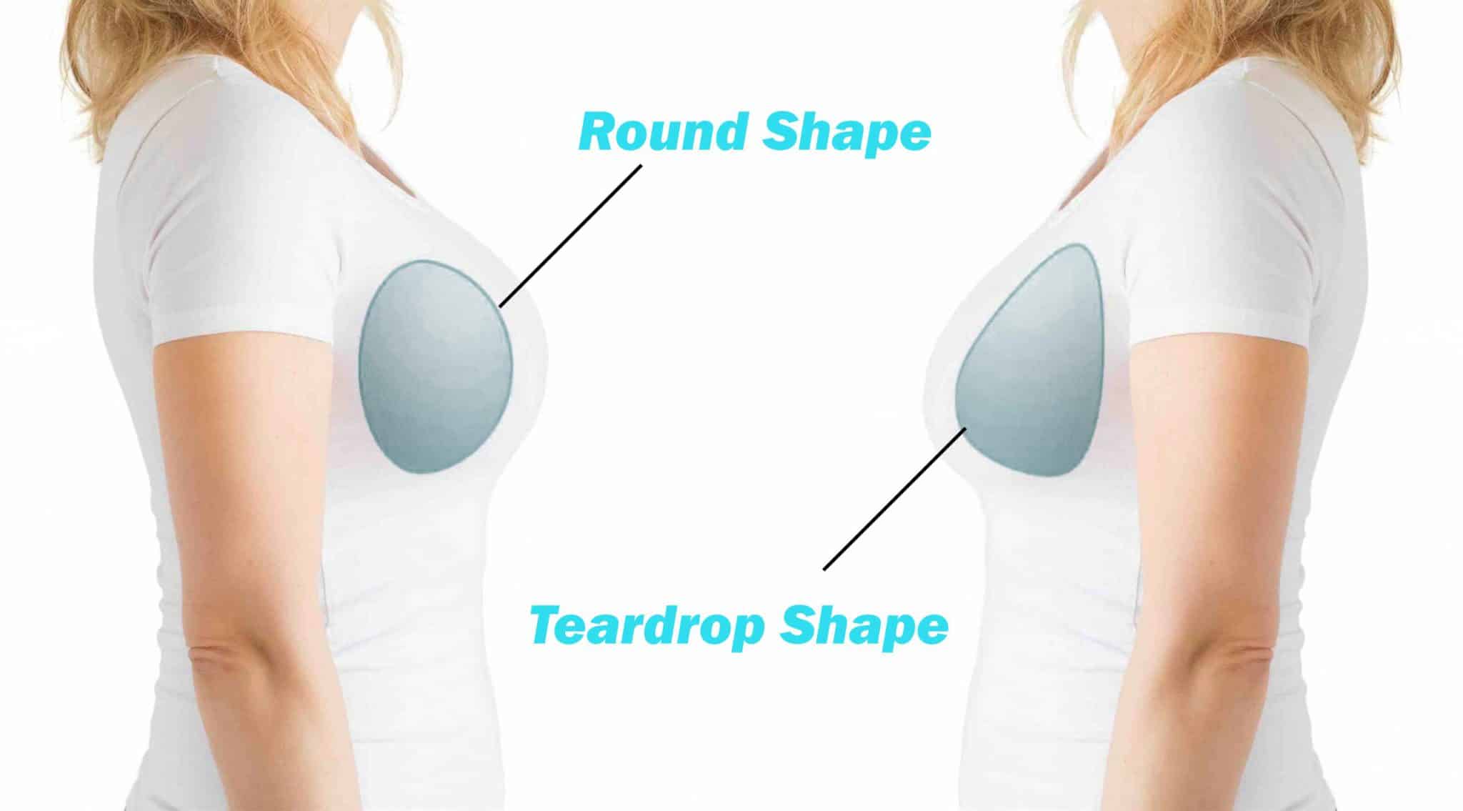 Teardrop Breast Augmentation