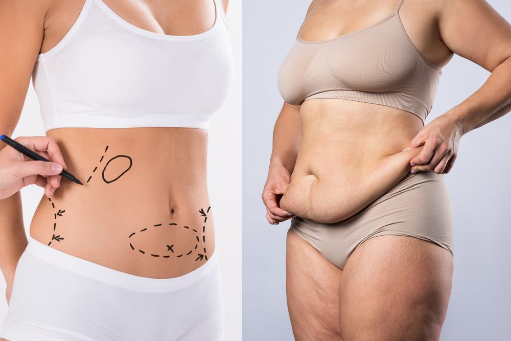 Liposuction 360 vs Tummy Tuck: Clearing up the confusion