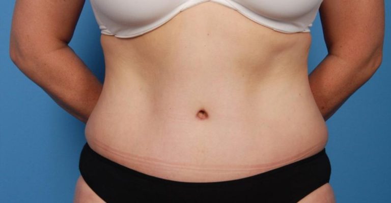 mini tummy tuck belly button