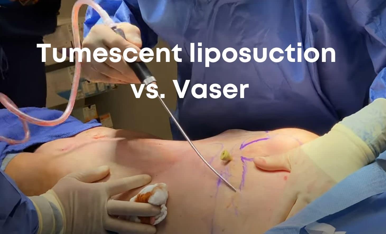 Smart Lipo vs Tumescent Liposuction: Definitions, Benefits
