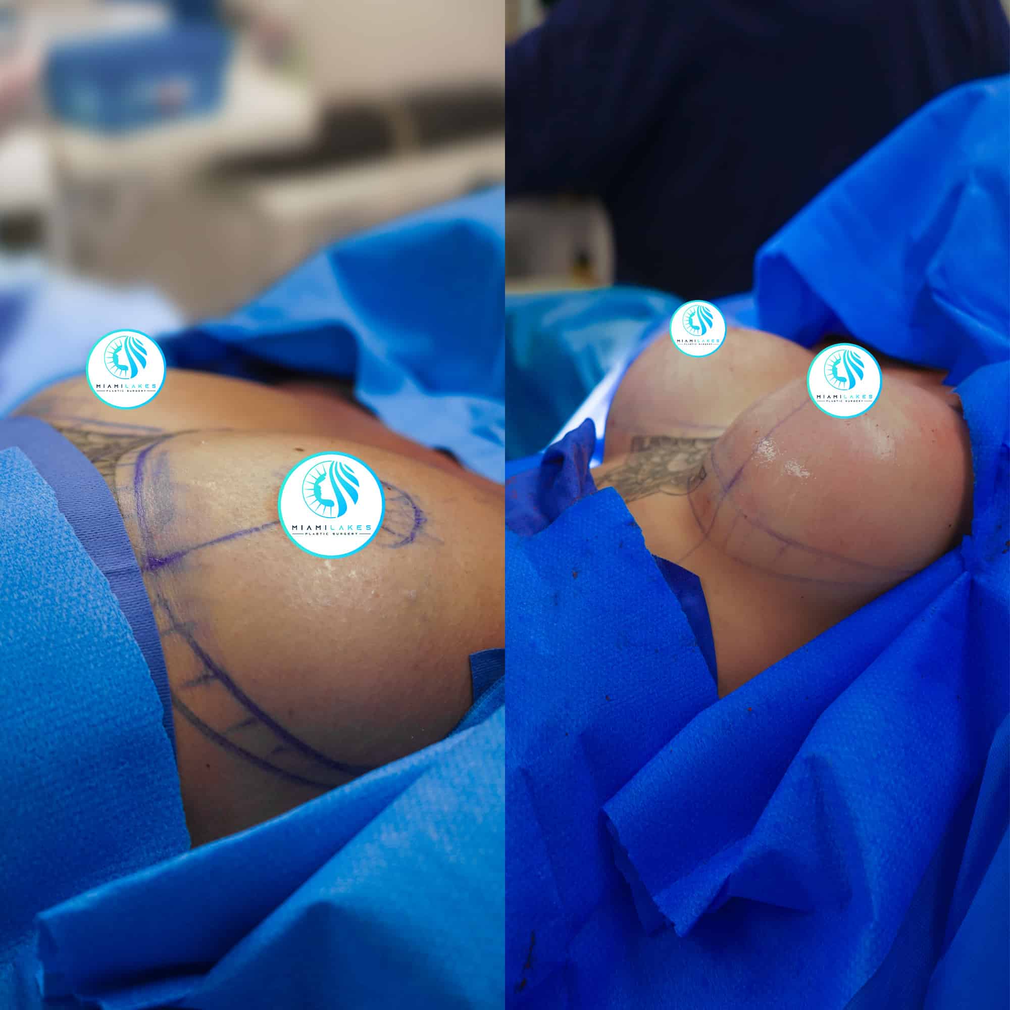 Vanity Fair Bras For Breast Augmentation - Miami Lakes Plastic Surgery