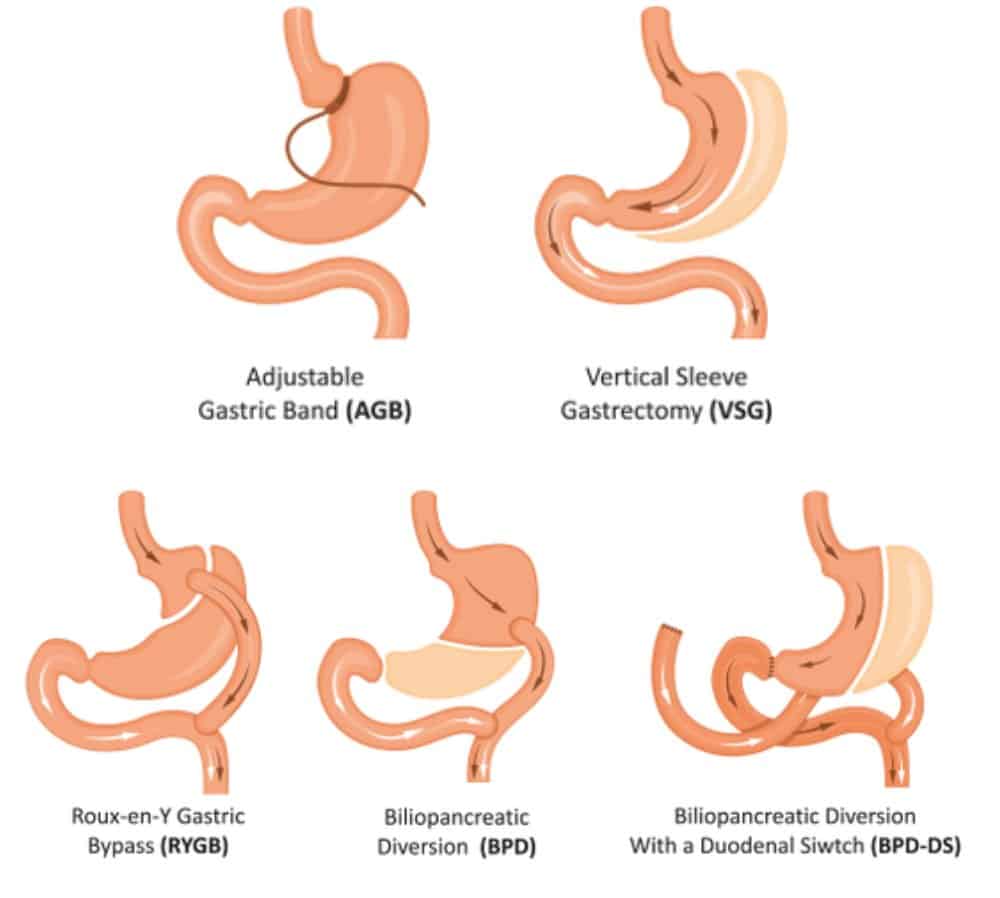 Gastric Sleeve, Sleeve Gastrectomy, VSG (Vertical Sleeve Gastrectomy)  Surgery - Bariatric Surgery