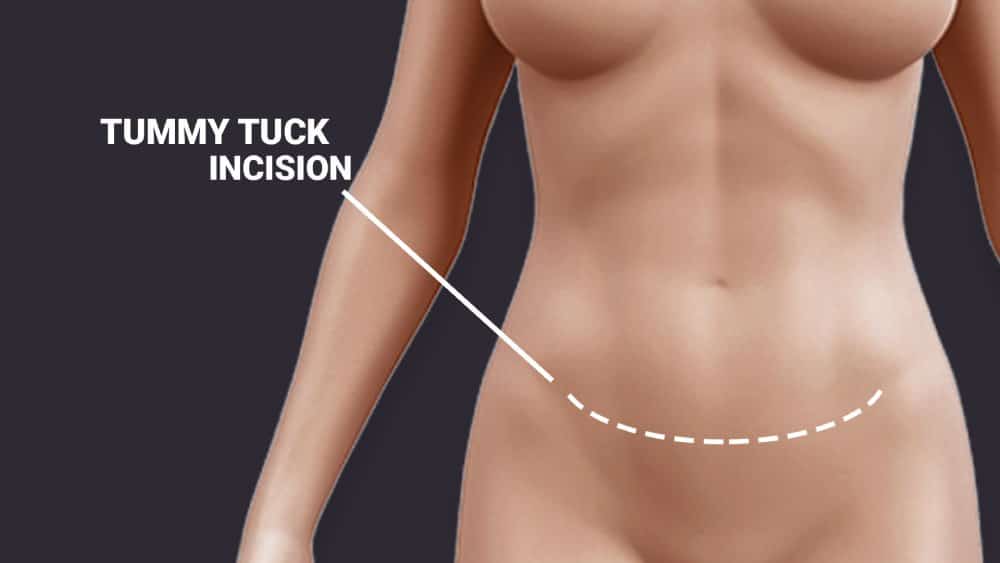 Cuáles Son Los Diferentes Tipos De Cirugía De Abdomen? - Spanish Hourglass  Tummy Tuck