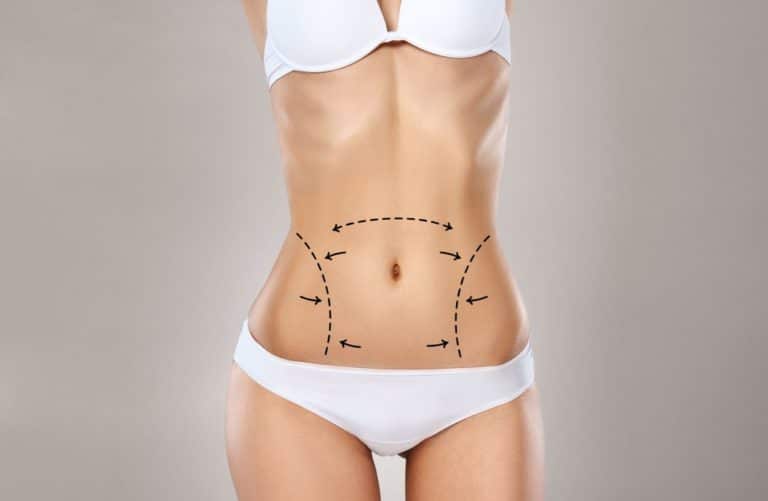 The Perfect Pair: SMART Tummy Tuck & 360-Degree Liposuction