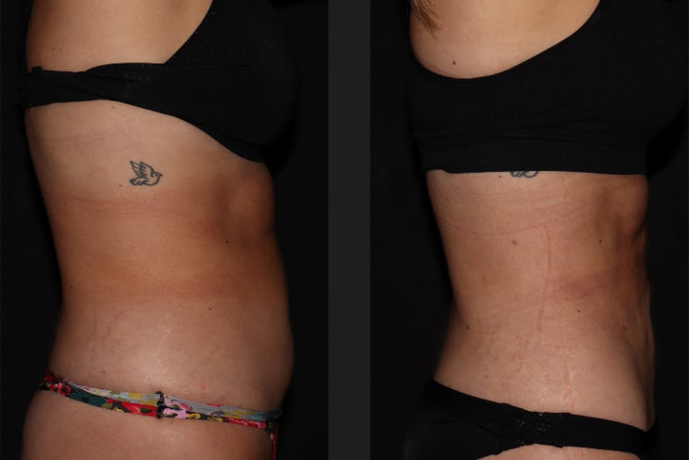 How Soon Will You See Results After Nonsurgical Body Contouring?